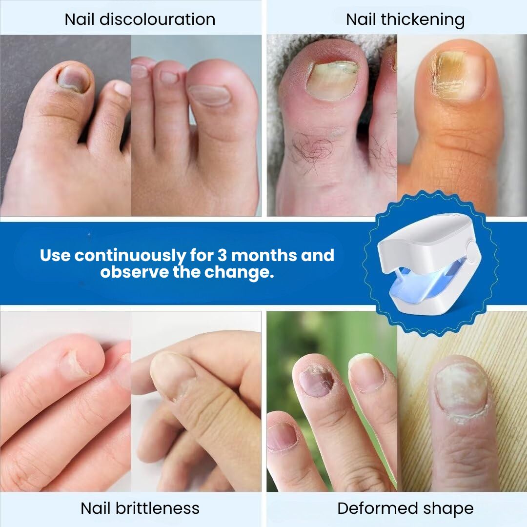 DermaNail – Patented nail fungus therapy – for healthy nails within 4 weeks Success