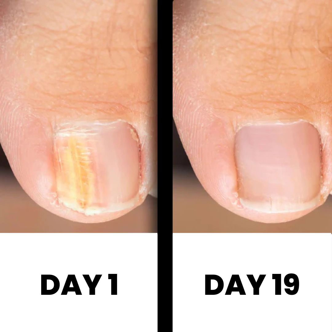 DermaNail – Patented nail fungus therapy – for healthy nails within 4 weeks Success