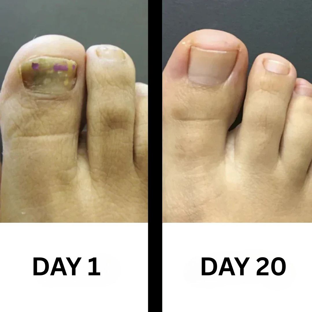 PureNail - Patented nail fungus therapy – for healthy nails within 4 weeks
